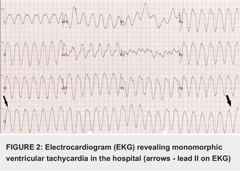 Figure 2 From A Rare Case Of Loperamide Induced Cardiac Arrest