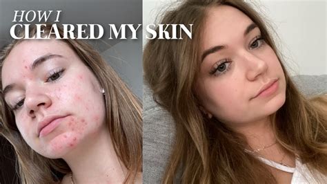 My Skincare Journey My Accutane Experience And Fungal Acne Youtube