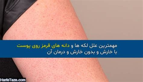 مهمترین علل دانه های قرمز روی پوست با خارش و بدون خارش و درمان آن