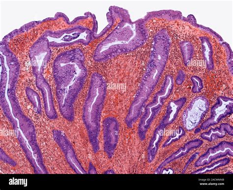 Hyperplastic Polyp Light Micrograph Of A Section Through A