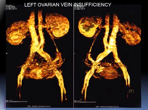 Pelvic Congestion Syndrome Treatment Midwest Vascular And Varicose