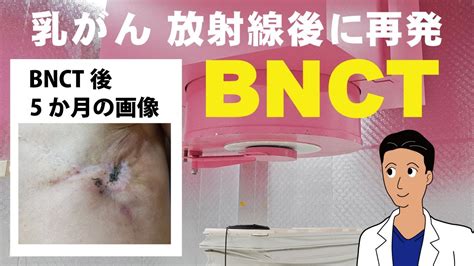 乳がんへのbnct （放射線治療後に再発、bnct治療を行った症例） 江戸川病院でbnct開始【概要欄へ】 Bnct 乳がん Youtube