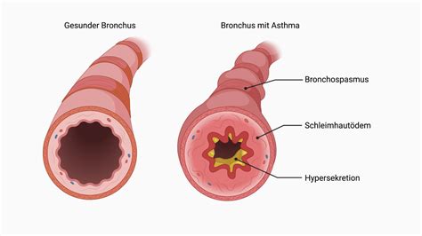 Asthma Trias DocCheck