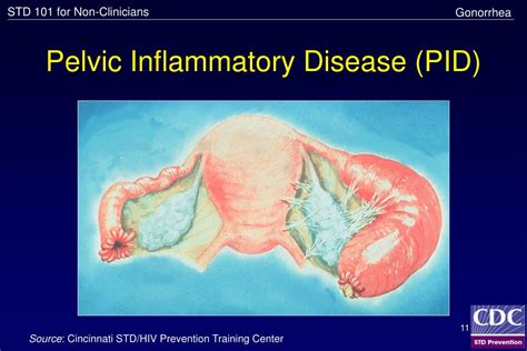 Ppt Common Sexually Transmitted Diseases Std 101 For Non Clinicians Powerpoint Presentation