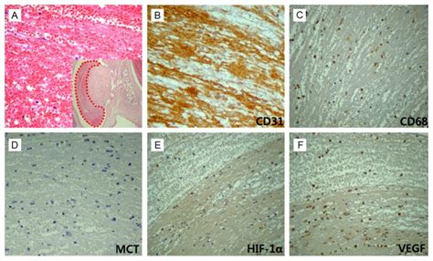 HIF 1α and VEGF expression correlates with thrombus remodeling in cases