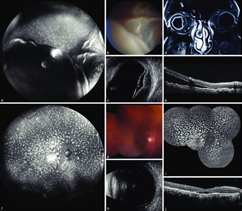 Uveal Effusion By A Wide Angle And B Macular Image With C