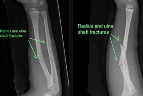 Forearm Fractures — Dr Carrie Kollias MD FRCSC FRACS Orthopaedic Surgeon