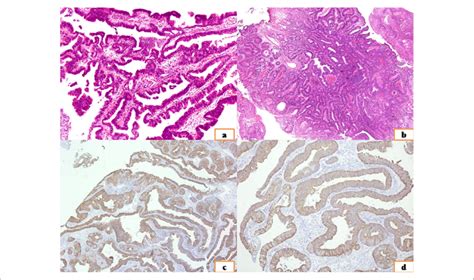 Two Cases Of Villous Adenoma Showing Villous A And Tubulovillous B