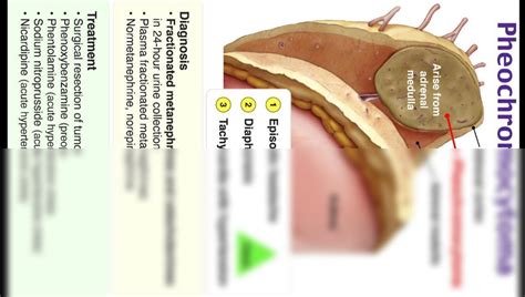 SOLUTION: Pheochromocytoma: Symptoms, diagnosis, and treatment - Studypool