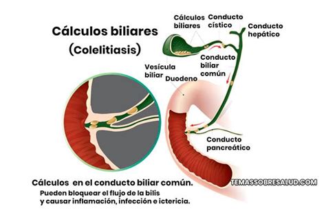 Litiasis Biliar Colelitiasis S Ntomas Causas Y Tratamiento The Best