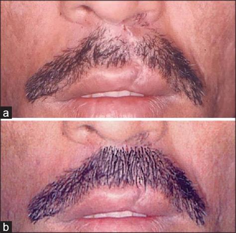 Cleft Lip Scar Treatment Through Hair Transplant In Lahore Pakistan