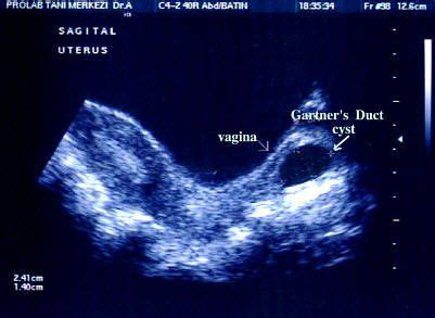 SAG Pelvis (Transabdominal) Gartner's Duct Cyst | Contemporary OB/GYN