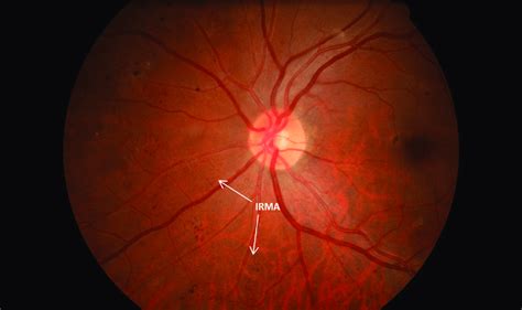 Severe Nonproliferative Diabetic Retinopathy With Intra Retinal Download Scientific Diagram