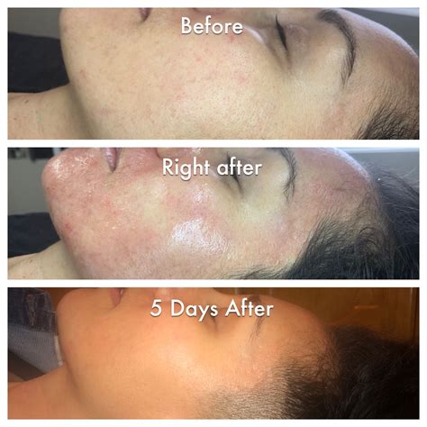 Gone Wrong Microneedling Before And After Treatment