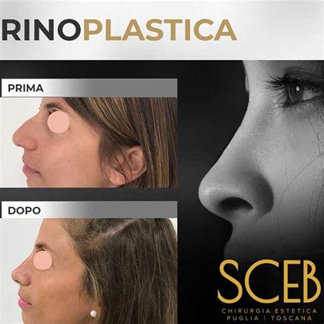 Rinoplastica Intervento Di Chirurgia Estetica Al Naso Sceb