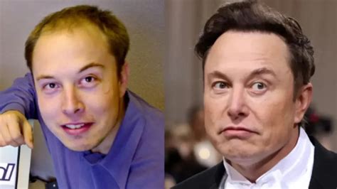 Did Elon Musk Have a Hair Transplant? Before and After