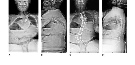 Ossos Fr Geis Osteog Nese Imperfeita E A Escoliose