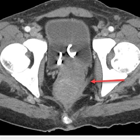 Ct Cross Sectional View Red Arrow Demonstrates Infiltrative Soft