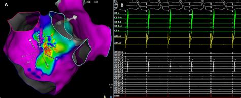 A Left Lateral View Of The Left Atrial Activation Map Post Left