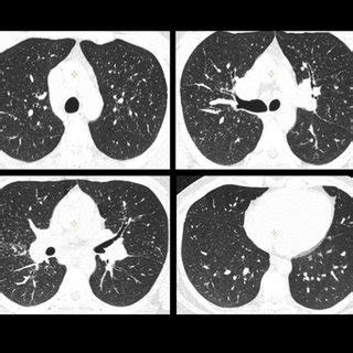 Pulmonary Sarcoidosis In A 30 Year Old Woman HRCT Scan Demonstrates