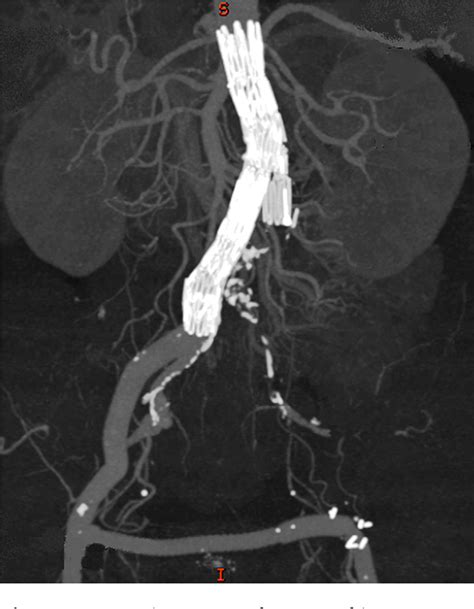 Figure From Endovascular Repair Of A Ruptured Abdominal Aortic