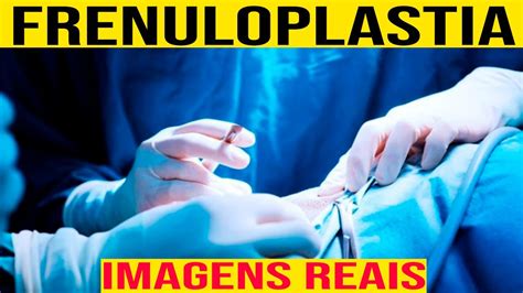 Frenuloplastia Imagens Reais Cirurgia Do Freio Do P Nis Youtube