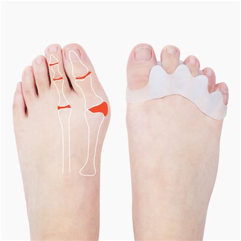 Pack Of Toe Separator Bunion Toe Spacer For Overlapping Hammer Toe