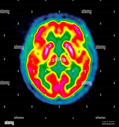 normal brain activity coloured positron emission tomography pet scan