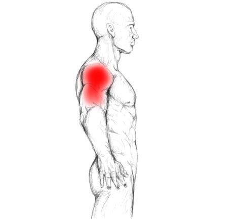 Deltoid muscle pain & trigger points