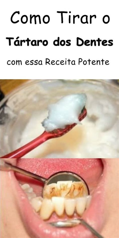 Como Tirar o Tártaro dos Dentes a Receita mais Potente Homemade