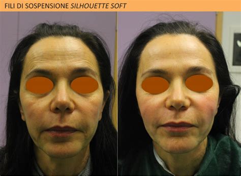 Fili Di Sospensione Silhouette Soft Lifting Senza Bisturidott Enis