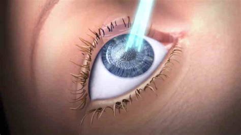 How Your Age Can Influence Your Laser Eye Surgery Options Smart Senior