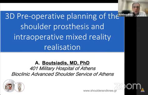 Preop Planning And Mixed Reality In Reverse Shoulder Arthroplasty