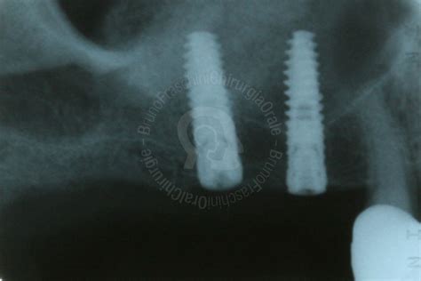 Maxillary Sinus Grafting Fraschini Chirurgia Orale