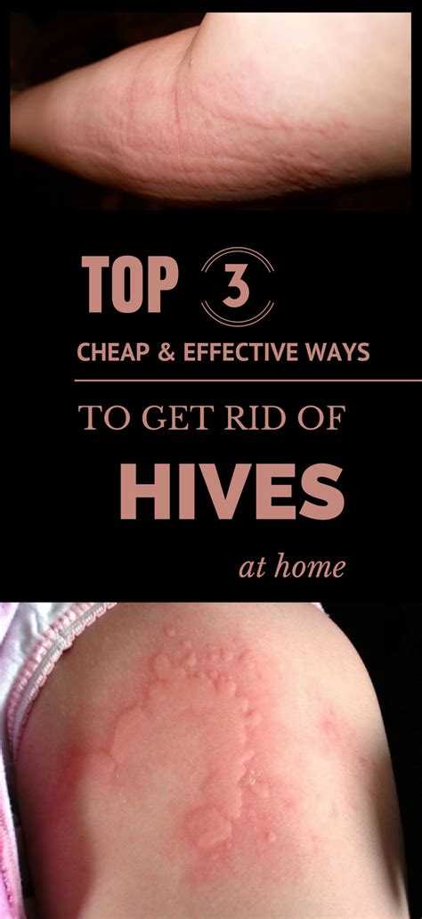 Top 3 Cheap And Effective Ways To Get Rid Of Hives At Home Hives Hives Remedies Healthy Advice