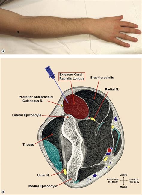 Anatomy for Needle Electromyography | Musculoskeletal Key