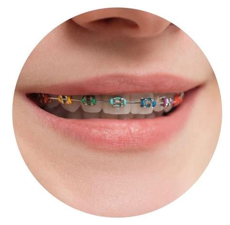 Colored Braces Dental Braces Braces Tips Dental