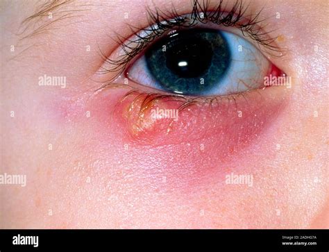 Herpes Simplex Close Up Des Auges Eines 2 Jährigen Mädchens Mit Einem