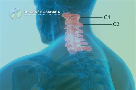 Esporão Ósseo Cervical Dr René Kusabara Cirurgião de Coluna