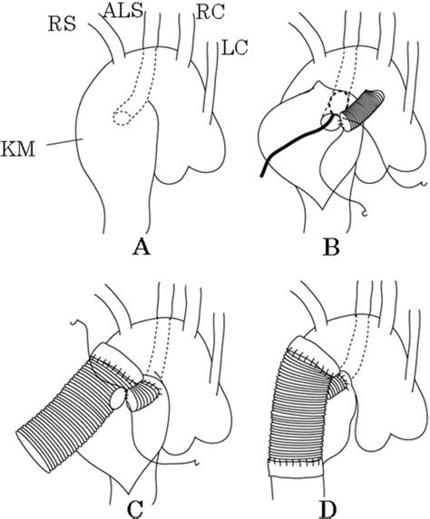 Surgical Treatment For Kommerells Diverticulum The Journal Of