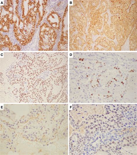 A The Tumor Cells Diffusely Expressed S100 Immunohistochemistry S100 Download Scientific