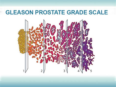 Prostate Cancer Staging And Grading What Is Gleason Score A