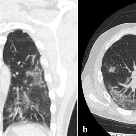 Bilateral Peripheral Ground Glass Attenuation And Patchy Consolidation