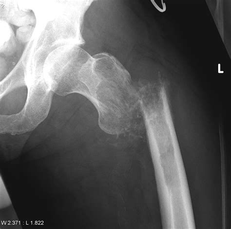 Pathological Fracture