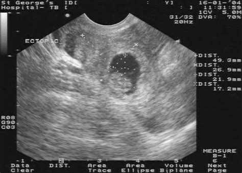 Ectopic Live Births