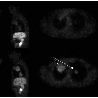 Baseline 18 F Fluoromisonidazole PET CT Bottom Row Showing Hypoxic