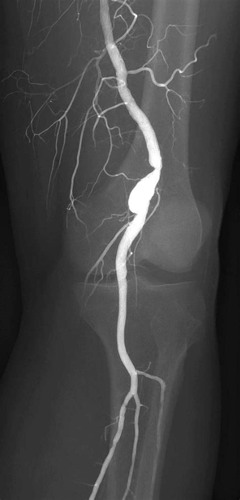 Aneurisma poplíteo tratamiento de esta lesión poco común y