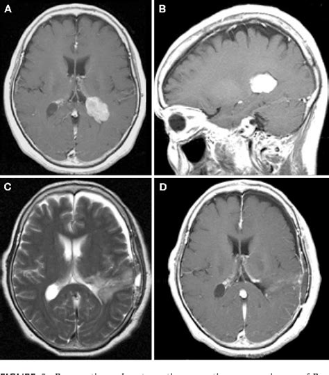 Figure 3 From Lateral Transsulcal Approach To Asymptomatic Trigonal