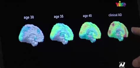 Eeuu Autoriza El Primer Medicamento Específico Contra El Alzhéimer En Décadas