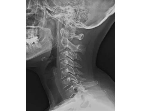 Lateral C-Spine X-ray Anatomy Quiz